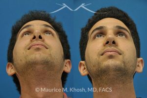 Photo of a patient before and after a procedure. Previous rhinoplasty in this young man had been a failure. The tip was raised too high, the nose was too short, and the tip was pinched. Revision rhinoplasty via the open approach successfully addressed the abnormalities and rendered the nose more aesthetic and natural in its appearance.