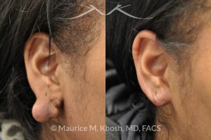 Photo of a patient before and after a procedure. Large keloid of earlobe