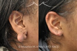 Photo of a patient before and after a procedure. Large keloid of earlobe