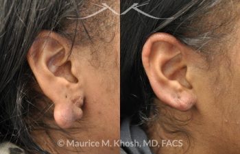 Cauliflower Ear Repair New York