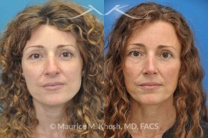 Photo of a patient before and after a procedure. Tip and bridge refinement - This young lady requested rhinoplasty to address dorsal hump, wide tip, and hanging columella. Surgery performed through the open rhinoplasty approach.