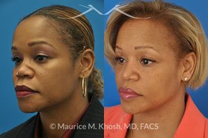 Photo of a patient before and after a procedure. Saddle Nose