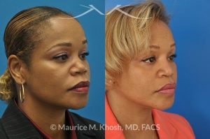 Photo of a patient before and after a procedure. Saddle Nose