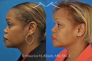 Photo of a patient before and after a procedure. Saddle Nose