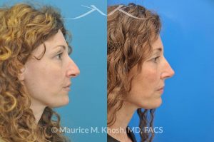 Photo of a patient before and after a procedure. Tip and bridge refinement - This young lady requested rhinoplasty to address dorsal hump, wide tip, and hanging columella. Surgery performed through the open rhinoplasty approach.