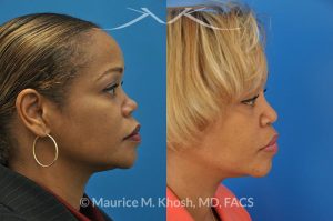 Photo of a patient before and after a procedure. Saddle Nose