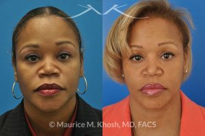 Photo of a patient before and after a procedure. Saddle Nose