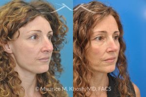 Photo of a patient before and after a procedure. Tip and bridge refinement - This young lady requested rhinoplasty to address dorsal hump, wide tip, and hanging columella. Surgery performed through the open rhinoplasty approach.