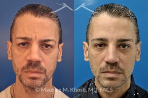 Photo of a patient before and after a procedure. 55 year old gentleman disliked the heavy and tired looking upper eyelid appearance. He underwent upper blepharoplasty to get rid of the sagging upper eyelids. He was additionally treated with Botox Cosmetic to improve the wrinkles in the forehead and smile lines. Patient had Voluma filler injections into cheek region to improve the aged appearance in the mid face.