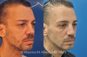 Photo of a patient before and after a procedure. 55 year old gentleman disliked the heavy and tired looking upper eyelid appearance. He underwent upper blepharoplasty to get rid of the sagging upper eyelids. He was additionally treated with Botox Cosmetic to improve the wrinkles in the forehead and smile lines. Patient had Voluma filler injections into cheek region to improve the aged appearance in the mid face.