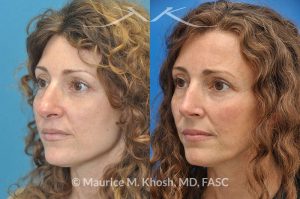 Photo of a patient before and after a procedure. Tip and bridge refinement - This young lady requested rhinoplasty to address dorsal hump, wide tip, and hanging columella. Surgery performed through the open rhinoplasty approach.