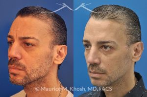 Photo of a patient before and after a procedure. Botox