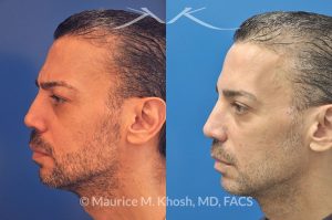 Photo of a patient before and after a procedure. Repair of nose fracture