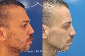 Photo of a patient before and after a procedure. Repair of nose fracture