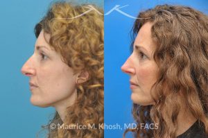 Photo of a patient before and after a procedure. Tip and bridge refinement - This young lady requested rhinoplasty to address dorsal hump, wide tip, and hanging columella. Surgery performed through the open rhinoplasty approach.