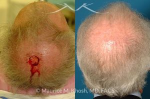 Photo of a patient before and after a procedure. Mohs defect scalp repair