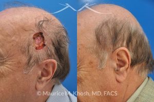 Photo of a patient before and after a procedure. Mohs' repair of scalp