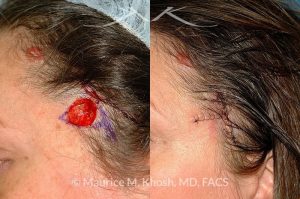 Photo of a patient before and after a procedure. Mohs defect scalp and temple
