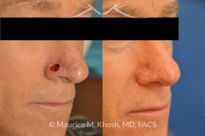 Photo of a patient before and after a procedure. Moh's defect of the nose repair