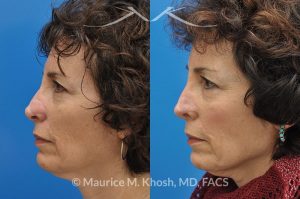 Photo of a patient before and after a procedure. Secondary repair of Moh's defect of the nose