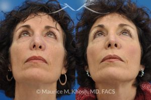 Photo of a patient before and after a procedure. Secondary repair of Moh's defect of the nose - before and after photos.