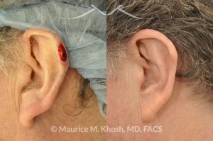 Photo of a patient before and after a procedure. Moh's defect