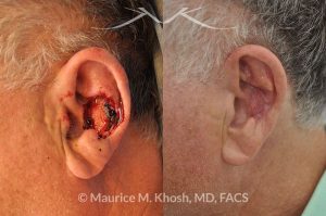 Photo of a patient before and after a procedure. Moh's repair of the ear with skin graft and composite graft