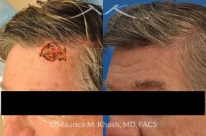 Photo of a patient before and after a procedure. Moh's repair of forehead scalp