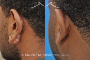 Photo of a patient before and after a procedure. Keloid of left ear