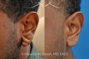 Photo of a patient before and after a procedure. Keloid of left ear