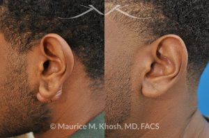 Photo of a patient before and after a procedure. Keloid of left ear