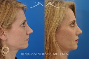 Photo of a patient before and after a procedure. Revision tip rhinoplasty with cartilage graft - This young lady complained of difficulty breathing, significant asymmetry of the nasal tip, and unnatural tip appearance on profile view of the nose following her primary rhinoplasty. The tip symmetry was restored and profile appearance was improved through revision tip rhinoplasty with cartilage grafts.