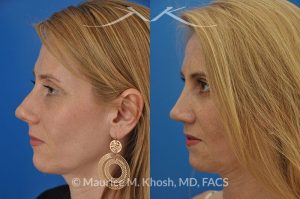 Photo of a patient before and after a procedure. This young lady complained of difficulty breathing, significant asymmetry of the nasal tip, and unnatural tip appearance on profile view of the nose following her primary rhinoplasty. The tip symmetry was restored and profile appearance was improved through revision tip rhinoplasty with cartilage grafts.