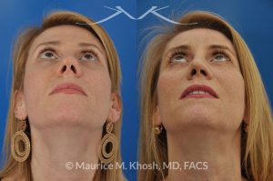 Photo of a patient before and after a procedure. Revision tip rhinoplasty with cartilage graft - This young lady complained of difficulty breathing, significant asymmetry of the nasal tip, and unnatural tip appearance on profile view of the nose following her primary rhinoplasty. The tip symmetry was restored and profile appearance was improved through revision tip rhinoplasty with cartilage grafts.