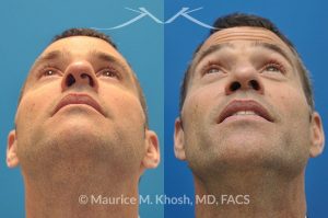 Photo of a patient before and after a procedure. Rhinoplasty for twisted nose