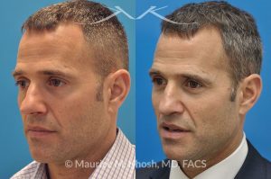 Photo of a patient before and after a procedure. Rhinoplasty for twisted nose
