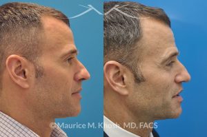 Photo of a patient before and after a procedure. Rhinoplasty for twisted nose