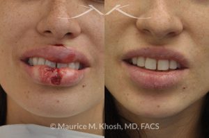 Photo of a patient before and after a procedure. Repair of lip laceratin - dog bite