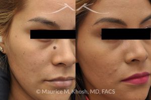 Photo of a patient before and after a procedure. Mole (nevus) removal from the face