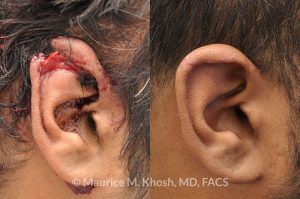 Photo of a patient before and after a procedure. Repair of ear laceration with exposed cartilage