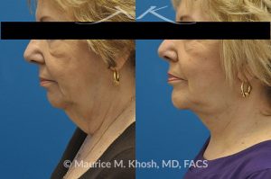 Photo of a patient before and after a procedure. Neck lift - This 70 year old lady with extensive laxity of skin in the central neck with droopy appearing neck and 'turkey wattles'. She was interested in achieving a younger, natural appearance to her neck.