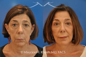 Photo of a patient before and after a procedure. Facelift - This 65 year old lady had previously undergone a facelift operation at age 48. She was unhappy with the aged appearance of her brow, eyes, mouth, and neck which made her look tired and sad. She underwent Revision SMAS facelift, endoscopic brow lift, upper and lower blepharoplasty.