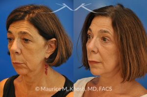Photo of a patient before and after a procedure. Brow lift - This 65 year old lady had previously undergone a facelift operation at age 48. She was unhappy with the aged appearance of her brow, eyes, mouth, and neck which made her look tired and sad. She underwent Revision SMAS facelift, endoscopic brow lift, upper and lower blepharoplasty.