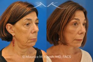Photo of a patient before and after a procedure. Brow lift - This 65 year old lady had previously undergone a facelift operation at age 48. She was unhappy with the aged appearance of her brow, eyes, mouth, and neck which made her look tired and sad. She underwent Revision SMAS facelift, endoscopic brow lift, upper and lower blepharoplasty.