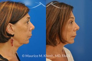 Photo of a patient before and after a procedure. Brow lift - This 65 year old lady had previously undergone a facelift operation at age 48. She was unhappy with the aged appearance of her brow, eyes, mouth, and neck which made her look tired and sad. She underwent Revision SMAS facelift, endoscopic brow lift, upper and lower blepharoplasty.