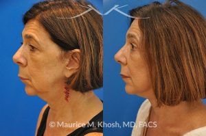 Photo of a patient before and after a procedure. Brow lift - This 65 year old lady had previously undergone a facelift operation at age 48. She was unhappy with the aged appearance of her brow, eyes, mouth, and neck which made her look tired and sad. She underwent Revision SMAS facelift, endoscopic brow lift, upper and lower blepharoplasty.