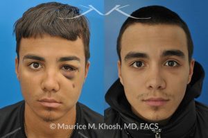 Photo of a patient before and after a procedure. Facial Fracture - This 19 year old had suffered a severely broken and displaced left cheek bone fracture due to a baseball injury. The left cheek bone had become flattened and he had lost his cheek projection. The broken bone was exposed thorough incisions inside the mouth and inside the eyelid, thereby eliminating any visible scars. The broken bones were realigned and stabilized with titanium plates.