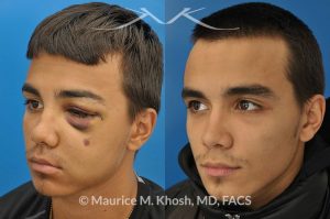 Photo of a patient before and after a procedure. Facial Fracture - This 19 year old had suffered a severely broken and displaced left cheek bone fracture due to a baseball injury. The left cheek bone had become flattened and he had lost his cheek projection. The broken bone was exposed thorough incisions inside the mouth and inside the eyelid, thereby eliminating any visible scars. The broken bones were realigned and stabilized with titanium plates.