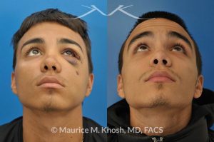 Photo of a patient before and after a procedure. Facial Fracture - This 19 year old had suffered a severely broken and displaced left cheek bone fracture due to a baseball injury. The left cheek bone had become flattened and he had lost his cheek projection. The broken bone was exposed thorough incisions inside the mouth and inside the eyelid, thereby eliminating any visible scars. The broken bones were realigned and stabilized with titanium plates.