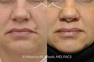 Photo of a patient before and after a procedure. Mole removal from the left upper lip